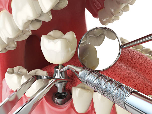 Best Emergency Dentist for Lost Fillings or Crowns in Brilliant, OH